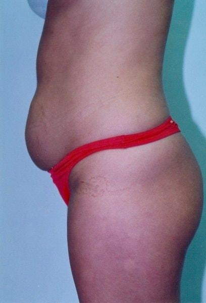 Mini Tummy Tuck before at Gillian Institute in Indianapolis, IN