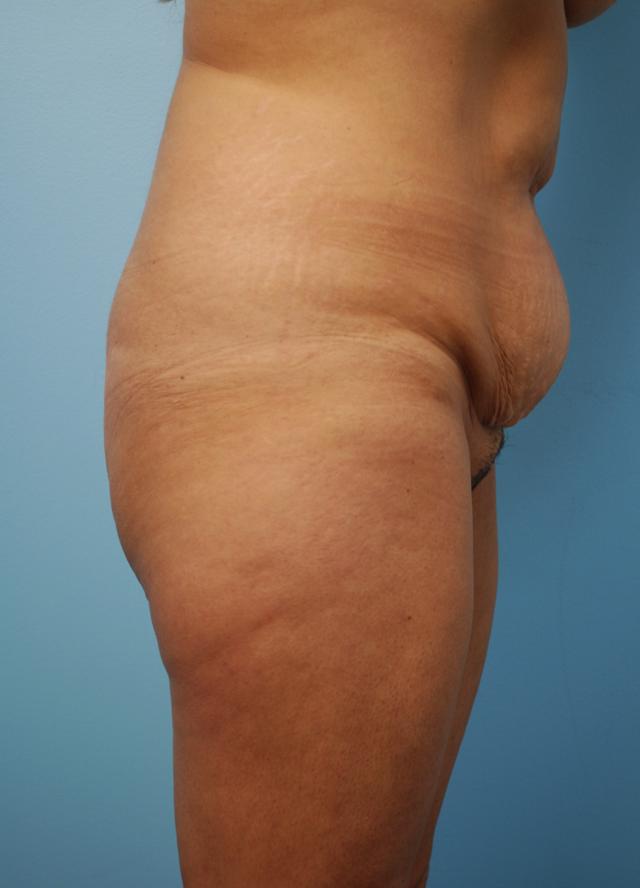 Mini Tummy Tuck before at Gillian Institute in Indianapolis, IN