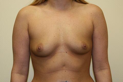 Breast Augmentation before at Gillian Institute in Indianapolis, IN
