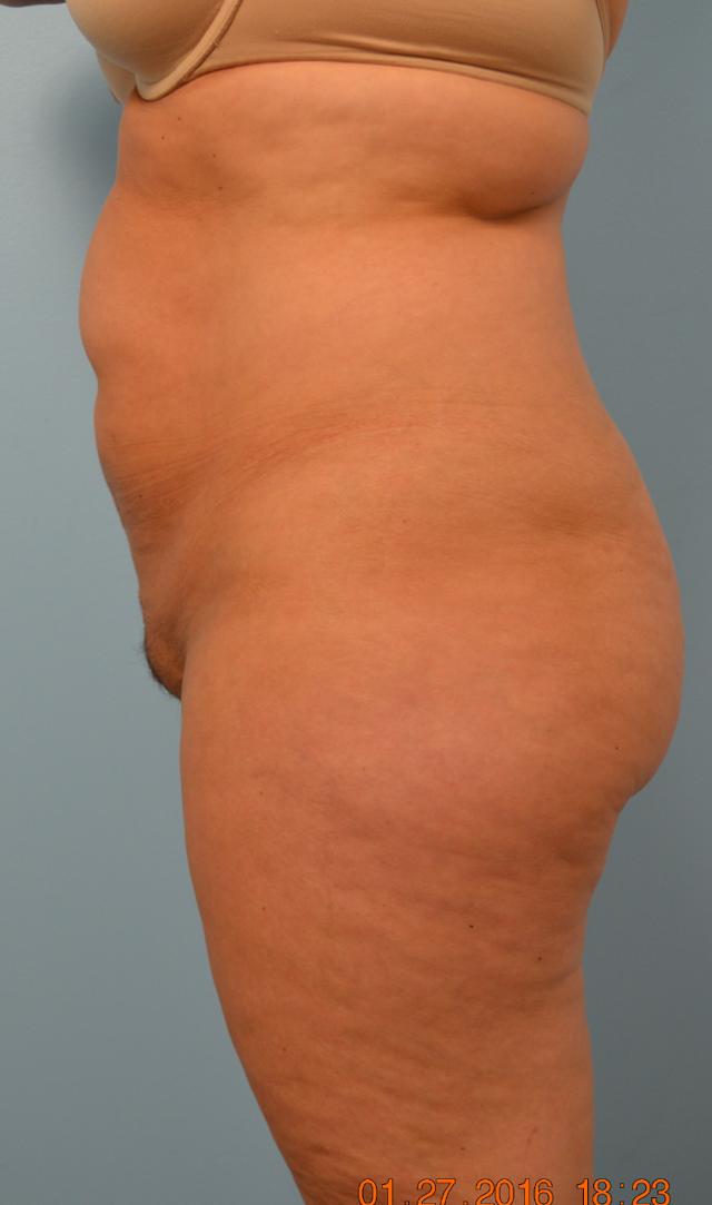 Liposuction before at Gillian Institute in Indianapolis, IN