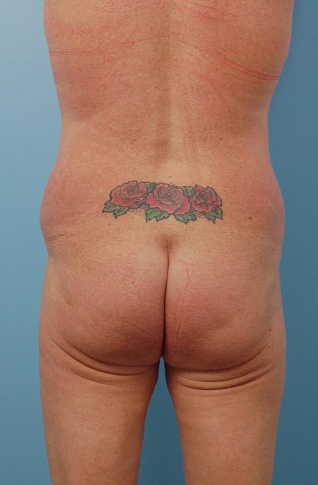Brazilian Butt Lift before at Gillian Institute in Indianapolis, IN