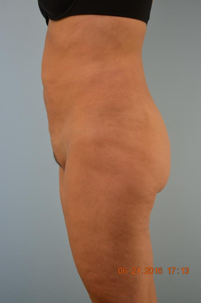 Liposuction after at Gillian Institute in Indianapolis, IN