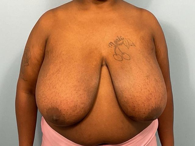 Breast Reduction before at Gillian Institute in Indianapolis, IN