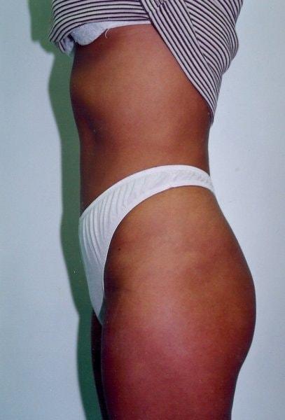 Gillian Institute tummy tuck after — Indianapolis, IN