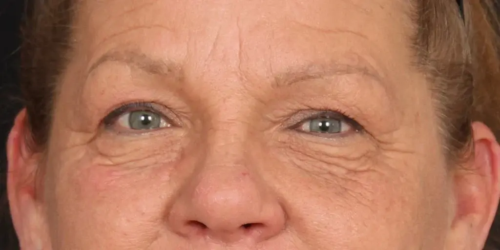 Davis Facial Plastics: Patrick K. Davis, MD blepharoplasty result — Beverly Hills, CA