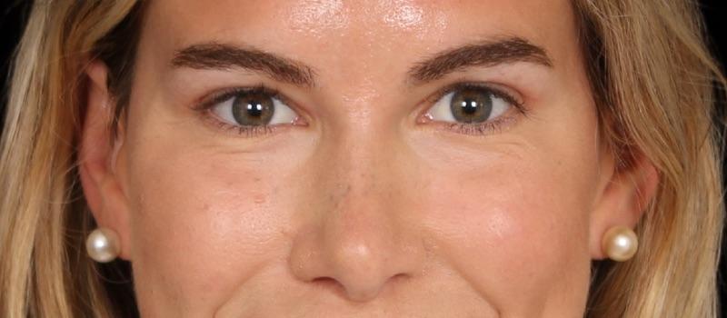 Davis Facial Plastics: Patrick K. Davis, MD blepharoplasty result — Beverly Hills, CA