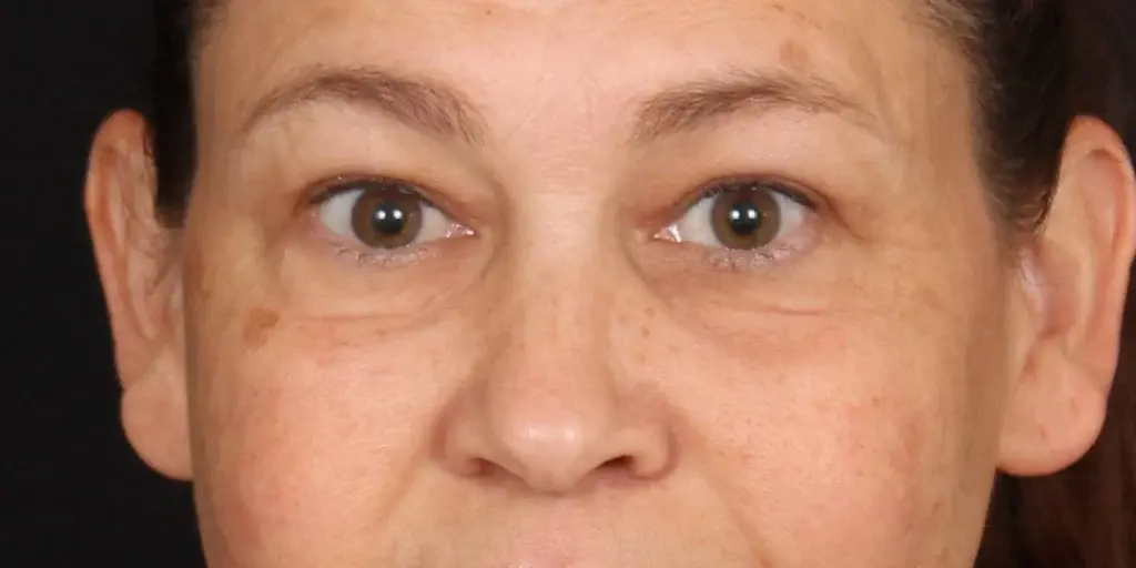Davis Facial Plastics: Patrick K. Davis, MD blepharoplasty result — Beverly Hills, CA