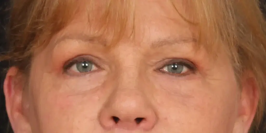 Davis Facial Plastics: Patrick K. Davis, MD blepharoplasty result — Beverly Hills, CA