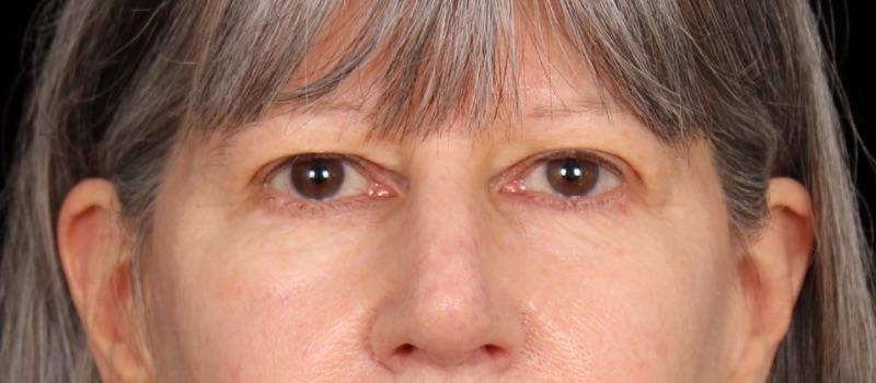 Davis Facial Plastics: Patrick K. Davis, MD blepharoplasty result — Beverly Hills, CA