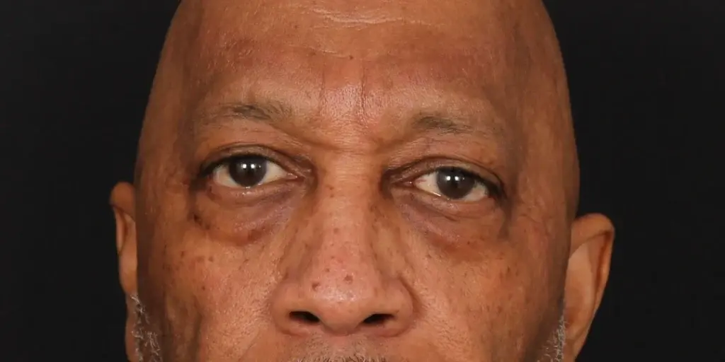 Davis Facial Plastics: Patrick K. Davis, MD eyelid lift result — Beverly Hills, CA