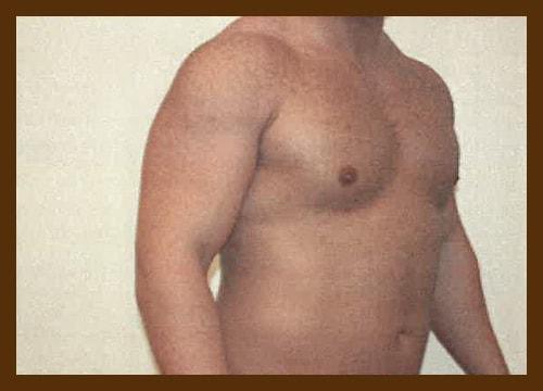 Gynecomastia Surgery after at Diaco Institute of Plastic Surgery in Tampa, FL