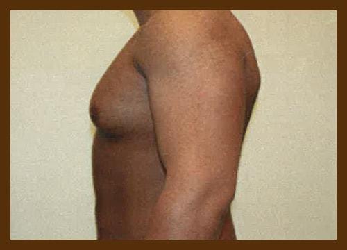 Gynecomastia Surgery before at Diaco Institute of Plastic Surgery in Tampa, FL