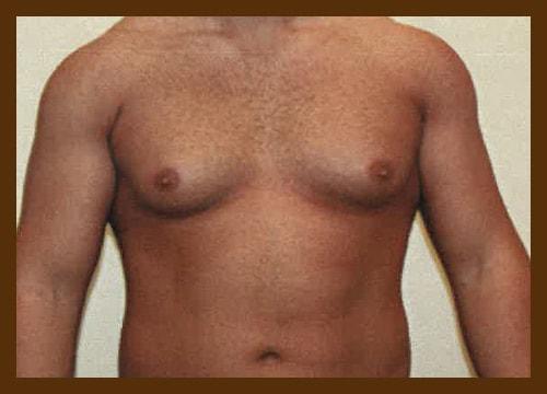 Gynecomastia Surgery before at Diaco Institute of Plastic Surgery in Tampa, FL