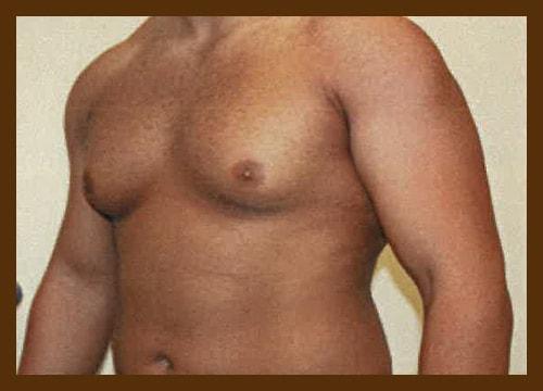 Gynecomastia Surgery before at Diaco Institute of Plastic Surgery in Tampa, FL