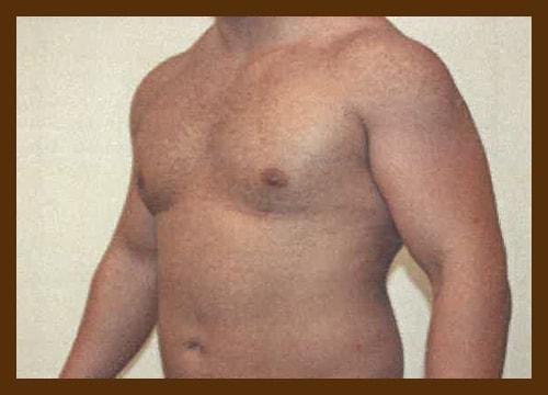 Gynecomastia Surgery after at Diaco Institute of Plastic Surgery in Tampa, FL