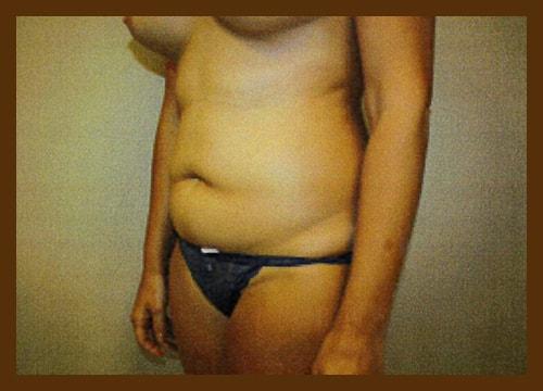 Mini Tummy Tuck before at Diaco Institute of Plastic Surgery in Tampa, FL
