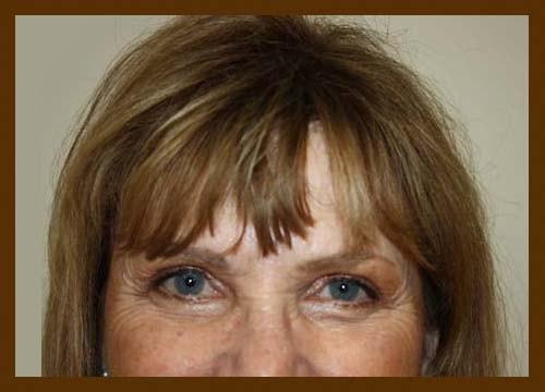 Diaco Institute of Plastic Surgery eyelid lift after — Tampa, FL