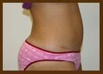 Diaco Institute of Plastic Surgery tummy tuck after — Tampa, FL
