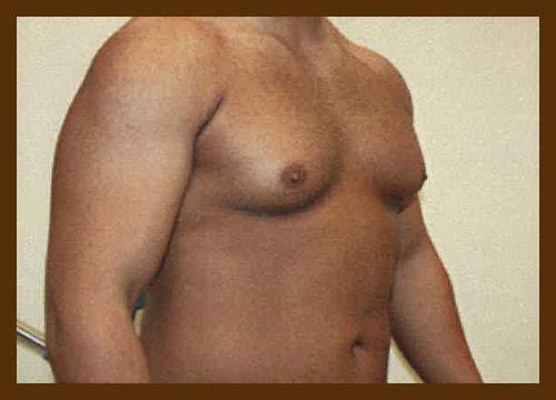 Gynecomastia Surgery before at Diaco Institute of Plastic Surgery in Tampa, FL