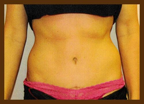 Diaco Institute of Plastic Surgery tummy tuck after — Tampa, FL