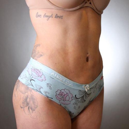 Liposuction after at Subbio Plastic Surgery & Medspa in Newtown Square, PA