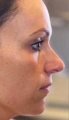 Subbio Plastic Surgery & Medspa liquid rhinoplasty after — Newtown Square, PA