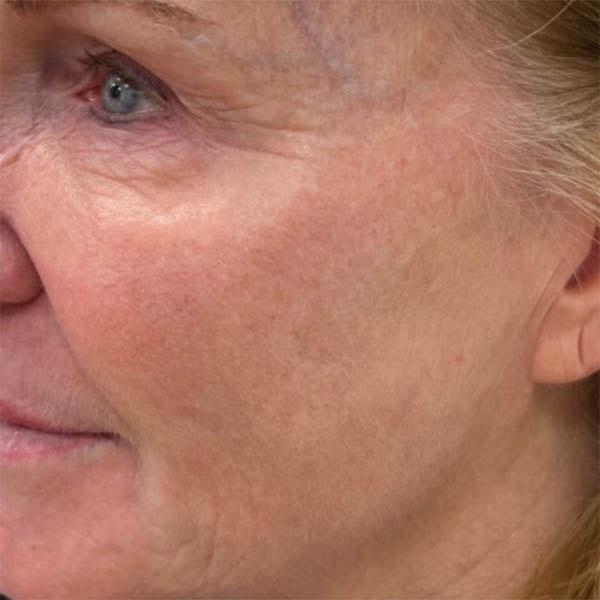 Subbio Plastic Surgery & Medspa photofacial after — Newtown Square, PA