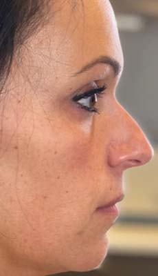Liquid Rhinoplasty before at Subbio Plastic Surgery & Medspa in Newtown Square, PA