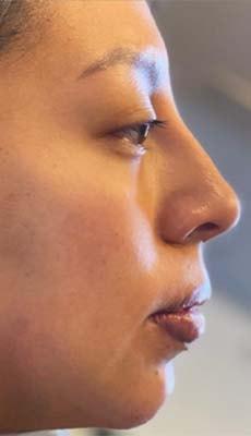 Liquid Rhinoplasty after at Subbio Plastic Surgery & Medspa in Newtown Square, PA