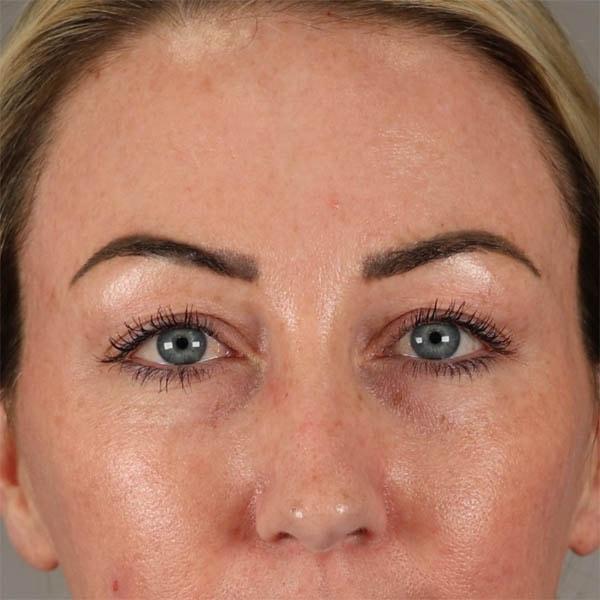Subbio Plastic Surgery & Medspa photofacial after — Newtown Square, PA