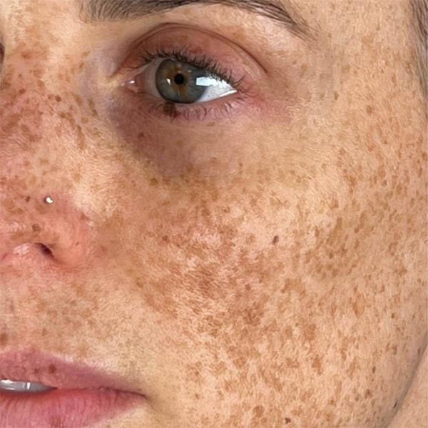 Microneedling before at Subbio Plastic Surgery & Medspa in Newtown Square, PA