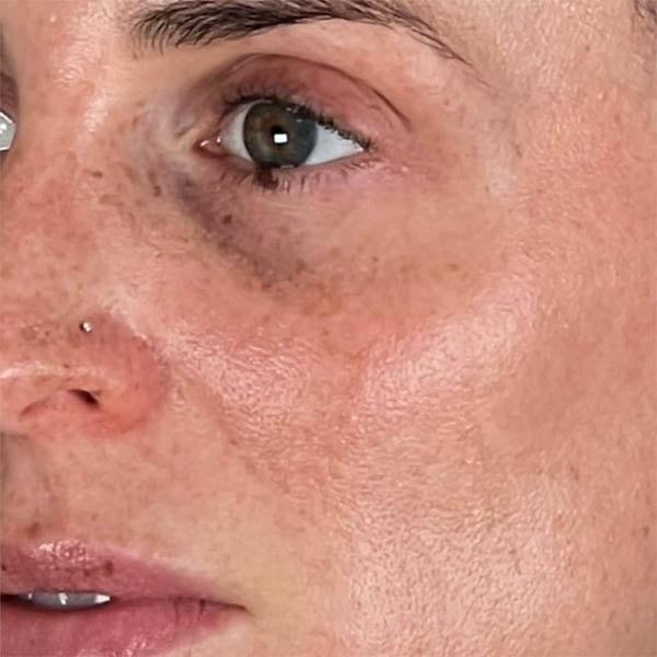 Subbio Plastic Surgery & Medspa photofacial after — Newtown Square, PA