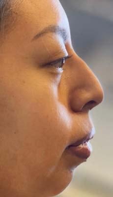 Liquid Rhinoplasty before at Subbio Plastic Surgery & Medspa in Newtown Square, PA