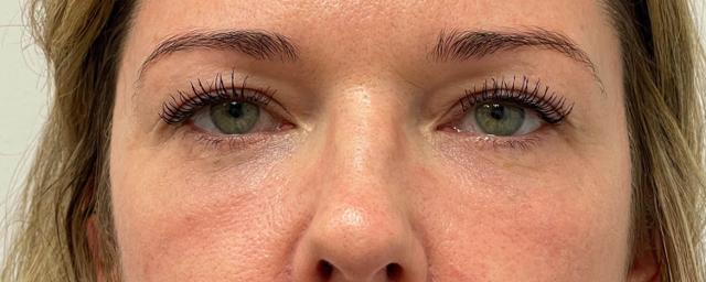 Blepharoplasty after at Subbio Plastic Surgery & Medspa in Newtown Square, PA