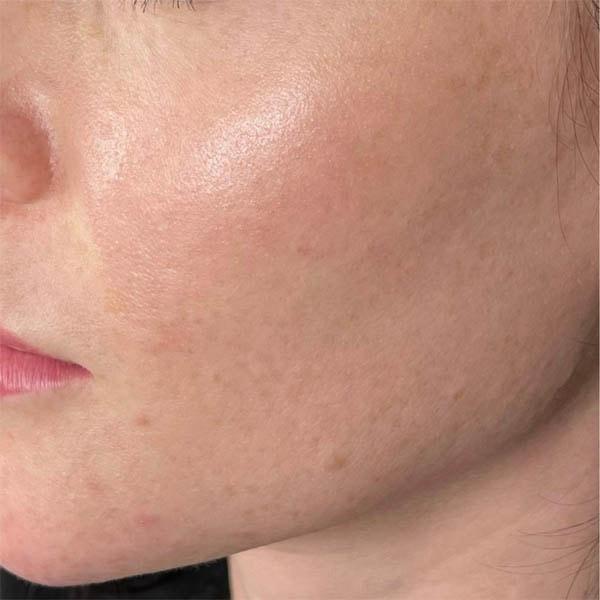Subbio Plastic Surgery & Medspa photofacial after — Newtown Square, PA