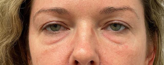 Blepharoplasty before at Subbio Plastic Surgery & Medspa in Newtown Square, PA