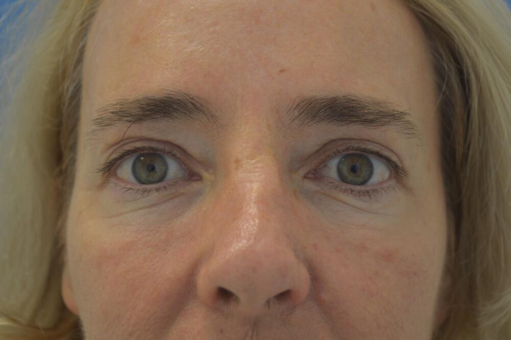 Stephan Baker, MD, FACS eyelid lift after — Miami, FL