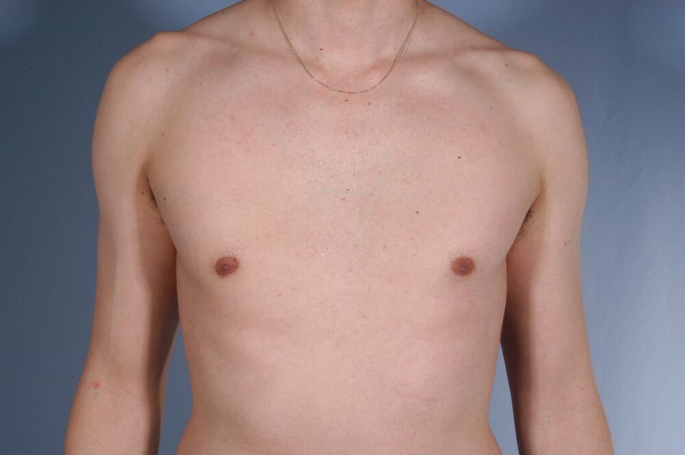 Stephan Baker, MD, FACS gynecomastia after — Miami, FL
