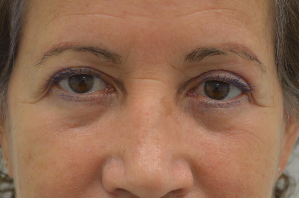 Stephan Baker, MD, FACS eyelid lift after — Miami, FL