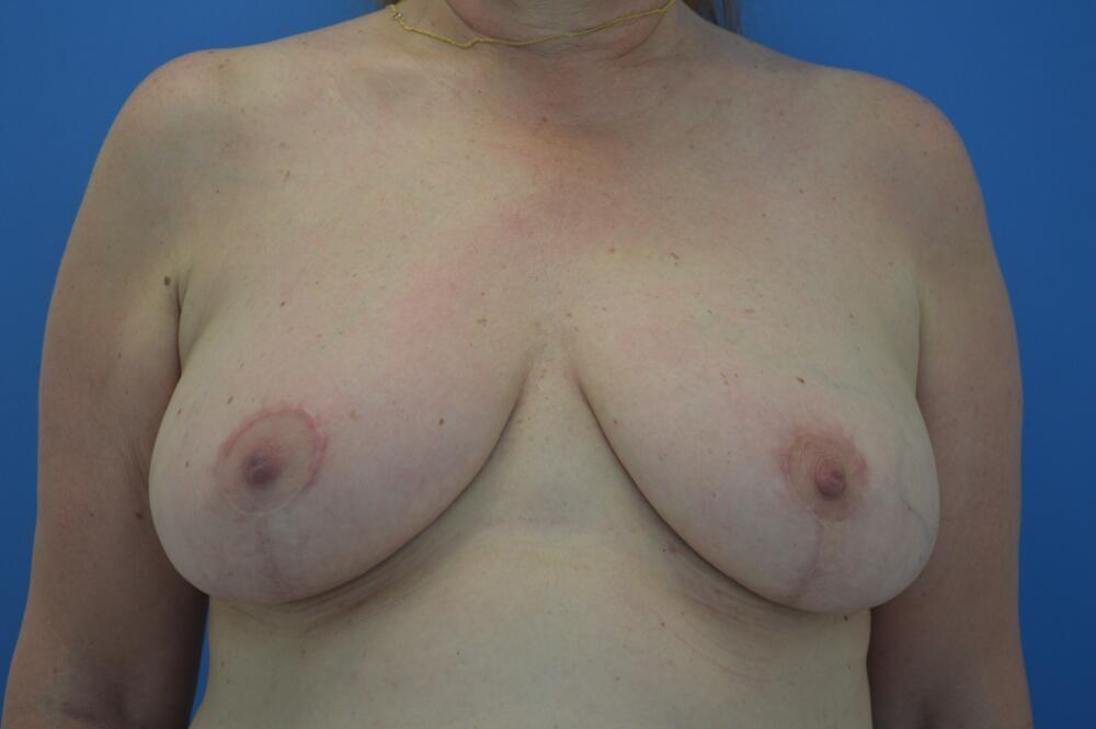 Stephan Baker, MD, FACS breast reduction after — Miami, FL