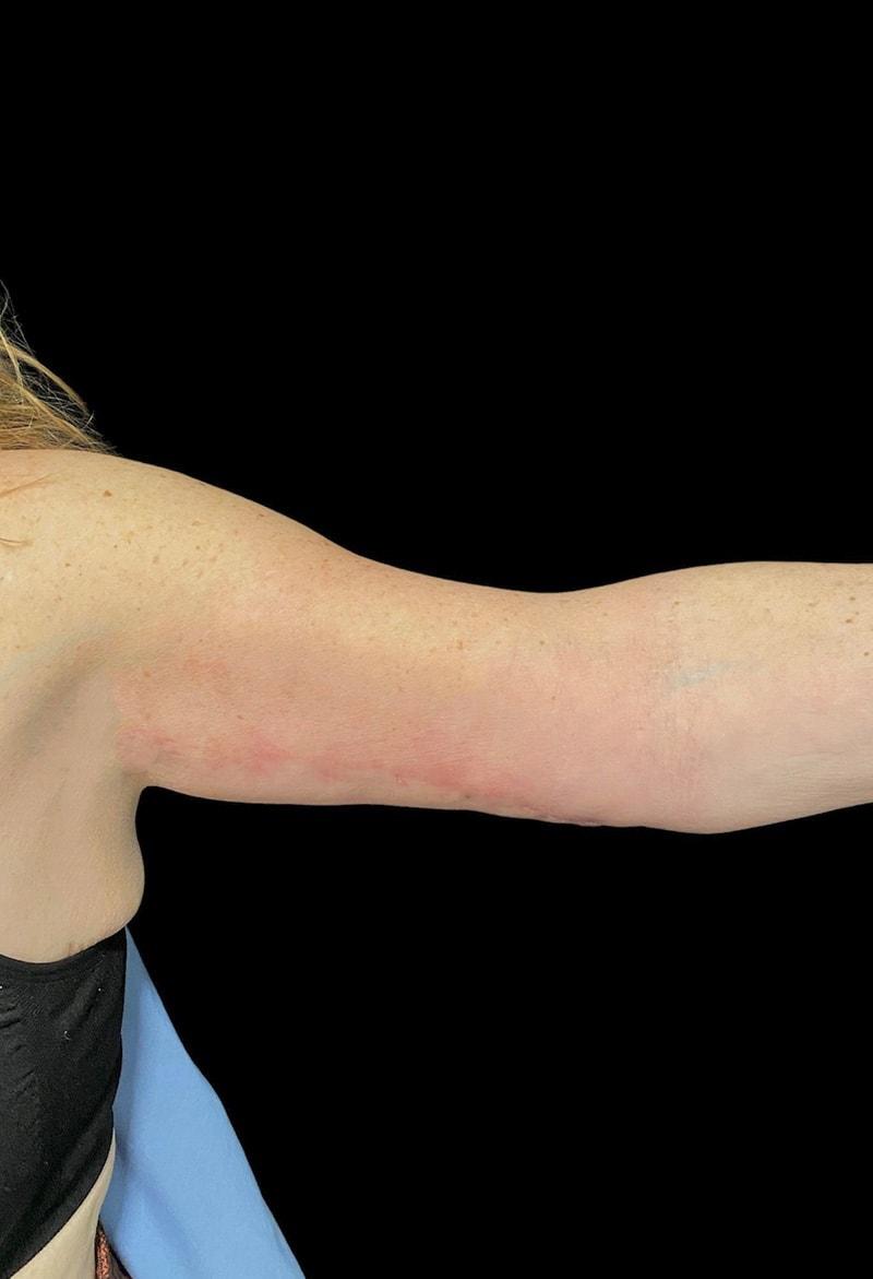Joshua B. Hyman, MD arm lift after — New York, NY
