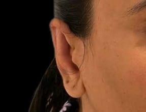 Joshua B. Hyman, MD ear pinning after — New York, NY