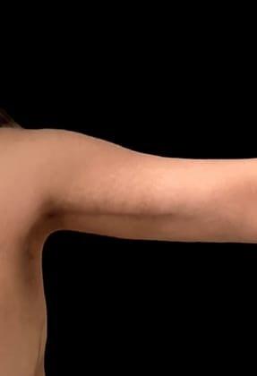 Joshua B. Hyman, MD arm lift after — New York, NY