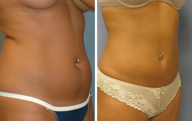 Liposuction result at ARTIS Institute - Dr. Sarraga in Aventura, FL