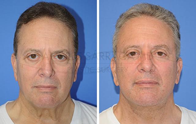 Facelift result at ARTIS Institute - Dr. Sarraga in Aventura, FL