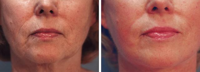 Laser Skin Resurfacing result at ARTIS Institute - Dr. Sarraga in Aventura, FL