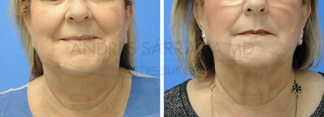 CoolSculpting result at ARTIS Institute - Dr. Sarraga in Aventura, FL