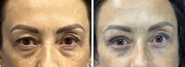 Blepharoplasty result at ARTIS Institute - Dr. Sarraga in Aventura, FL