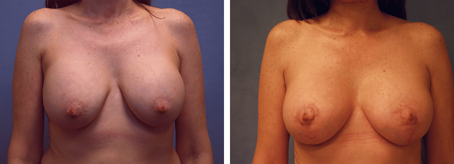 ARTIS Institute - Dr. Sarraga breast lift result — Aventura, FL