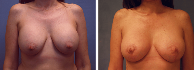 Breast Lift result at ARTIS Institute - Dr. Sarraga in Aventura, FL
